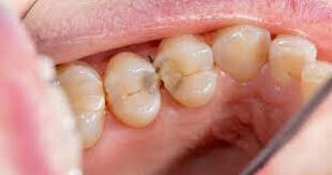 cavities-damages