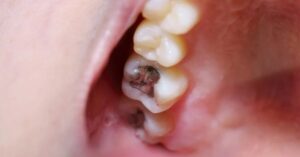 Cavities-cause-damage-of-teeth
